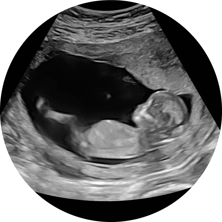 Early Ultrasound Gender Prediction